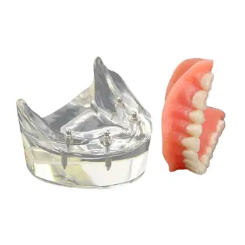 Демонстрационен модел за изучаване на зъбите Overdenture Inferior 4 Импланти